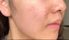 Reverse scar fade cream