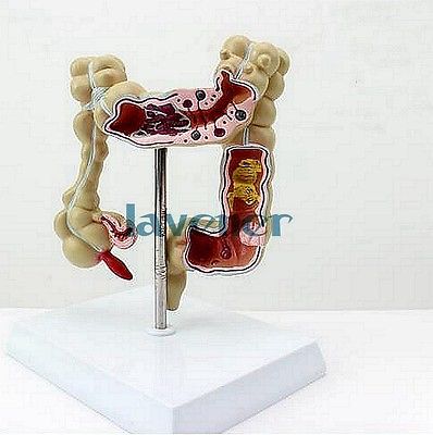 Human Anatomical Anatomy Colon Medical Pathology Model Digestive system